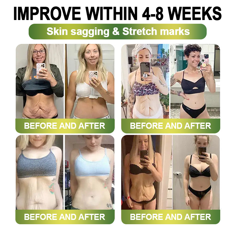 Clinically Proven|Official Store |Lenreey® NIDDK-Tirzepatide Slimming & health NANO MICRONEEDLE PATCH with Collagen & Matrixyl 3000丨Targets Obesity, Loose Skin, High Blood Pressure, Diabetes, Fatty Liver, Joint Pain, and More🌞